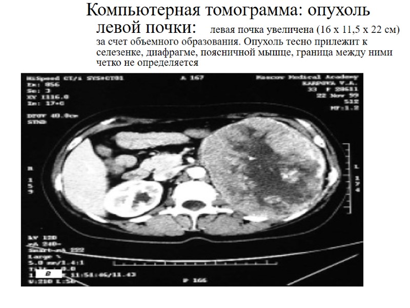 Компьютерная томограмма: опухоль левой почки:     левая почка увеличена (16 х